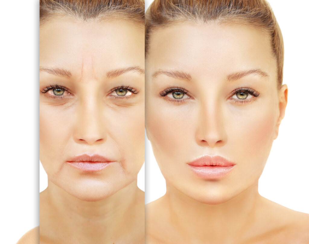 エステフィルビフォーアフター